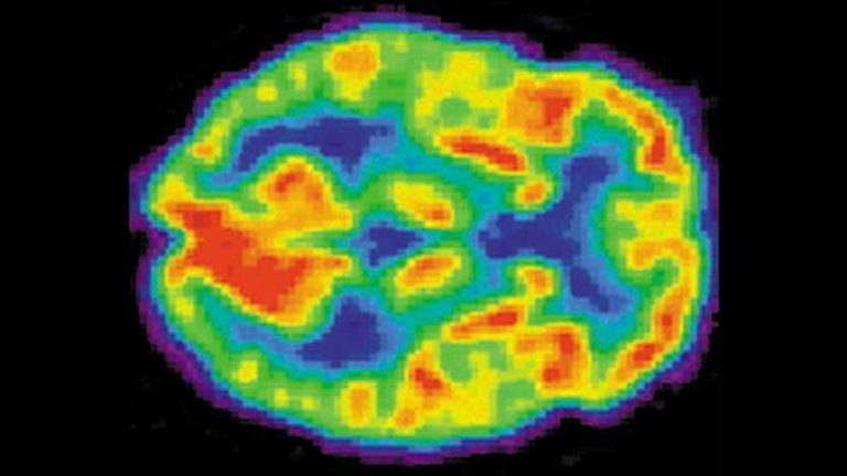 Some young NFL players have brain injuries