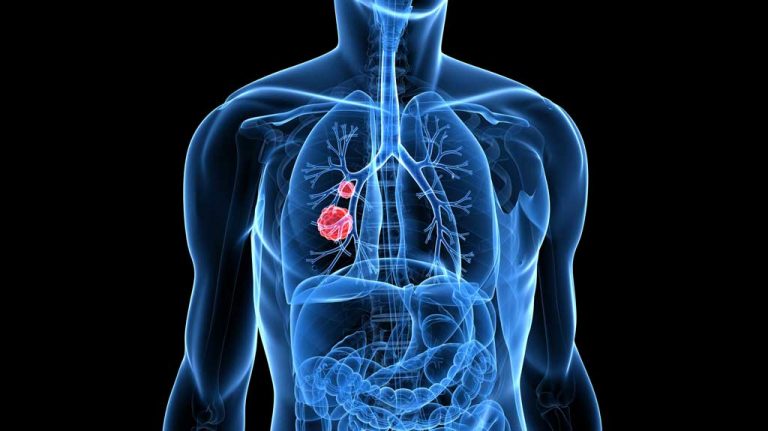 How is lung cancer like Hurricane Harvey?